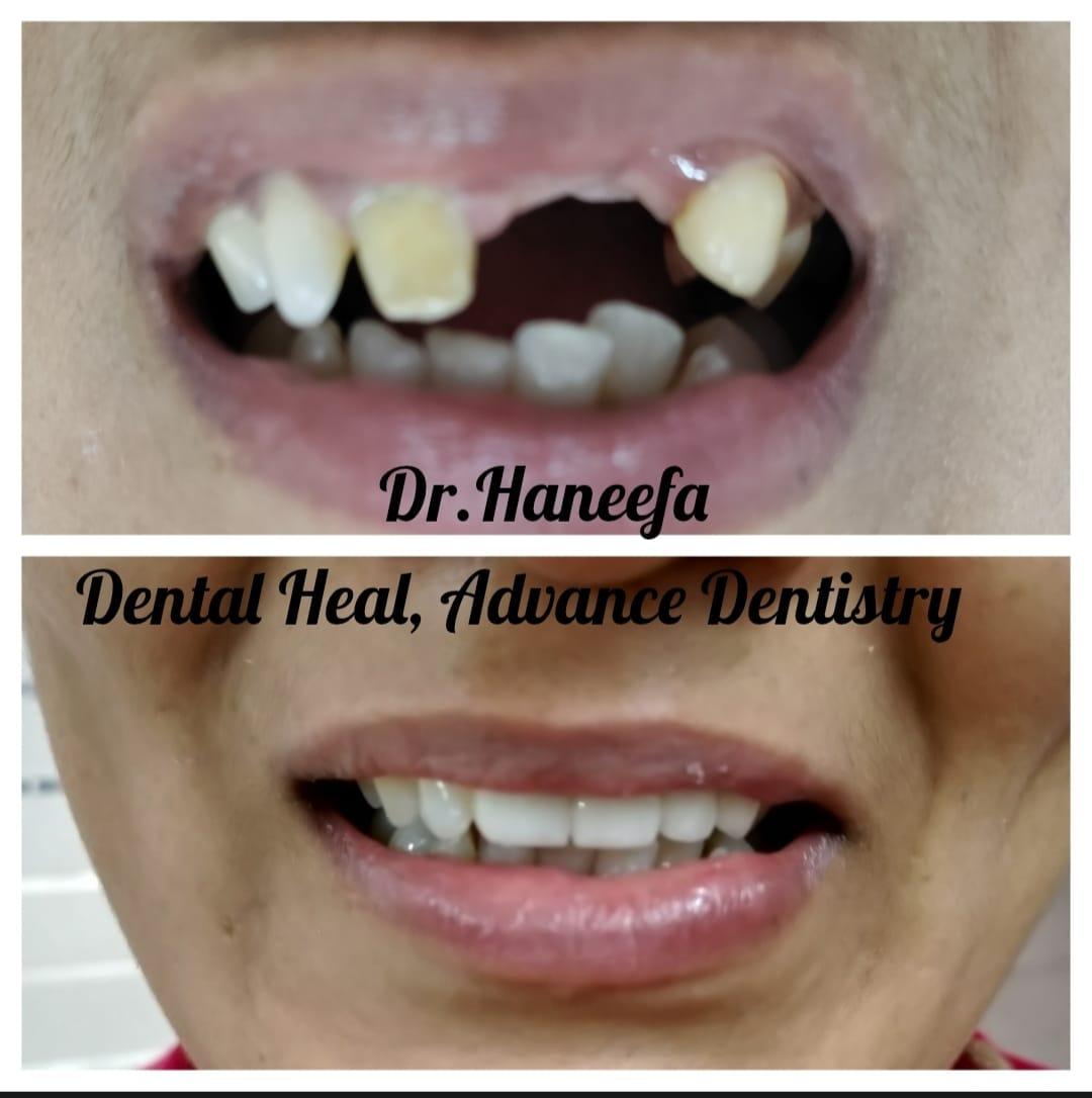 Dental transformation case 1
