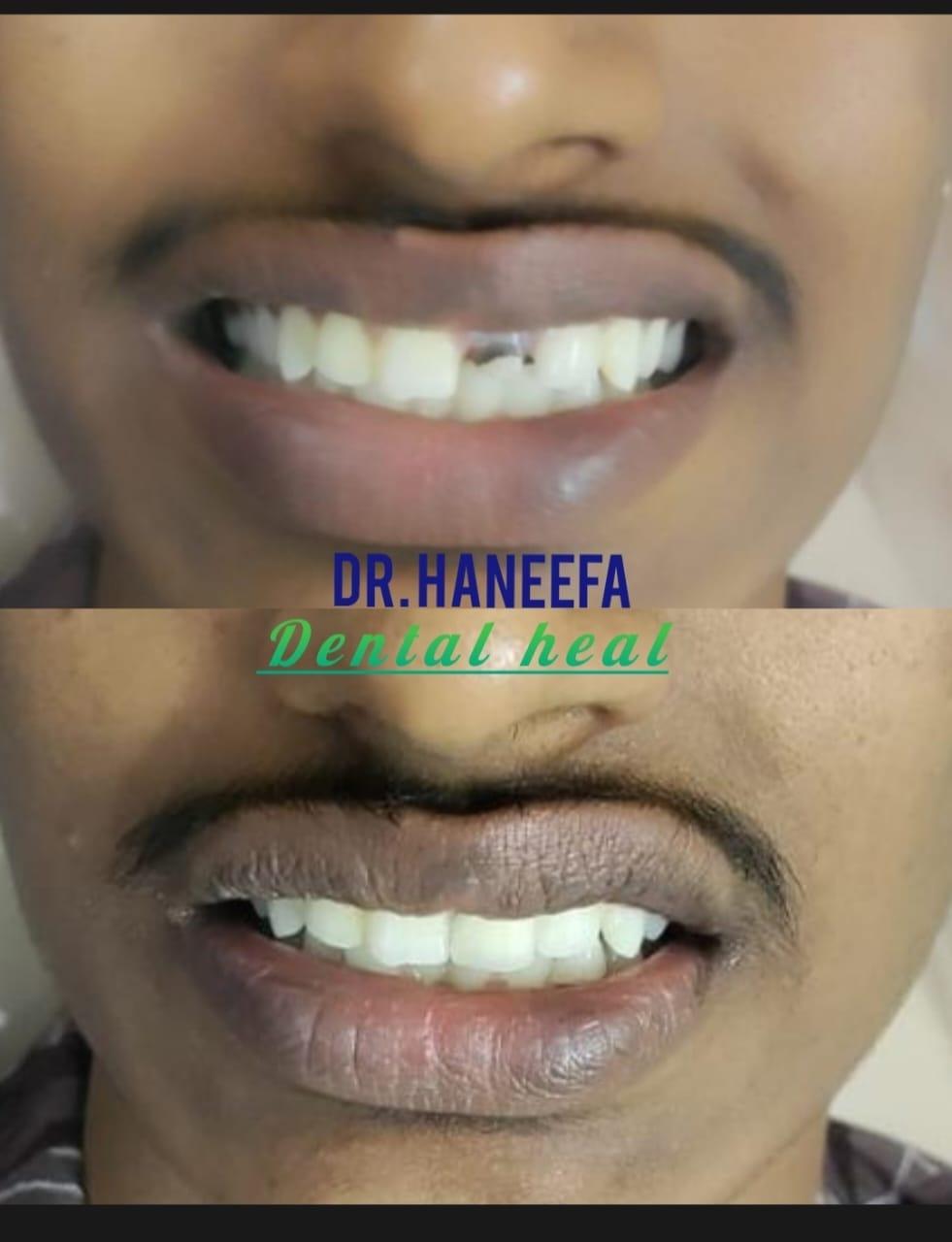 Dental transformation case 6
