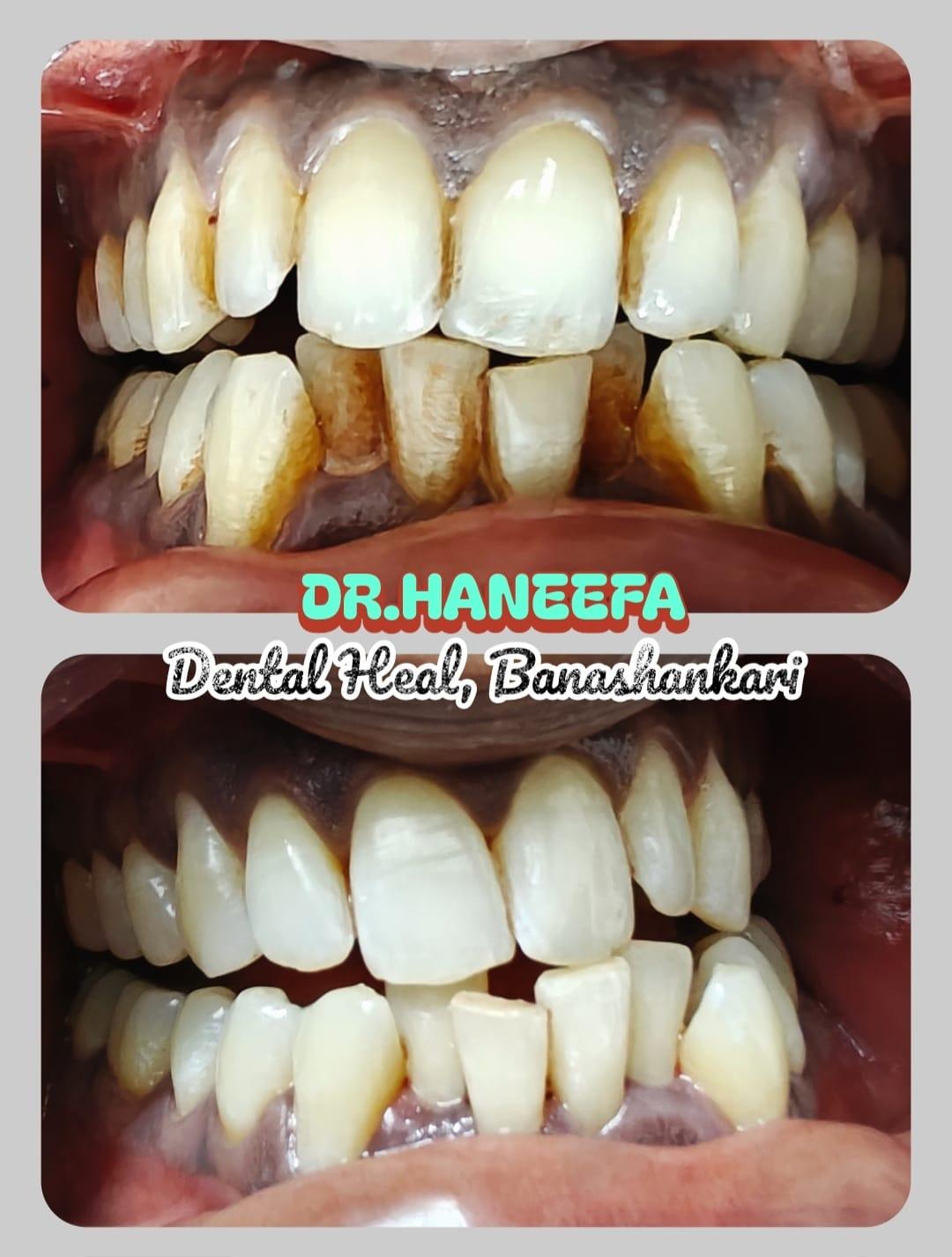 Dental transformation case 9